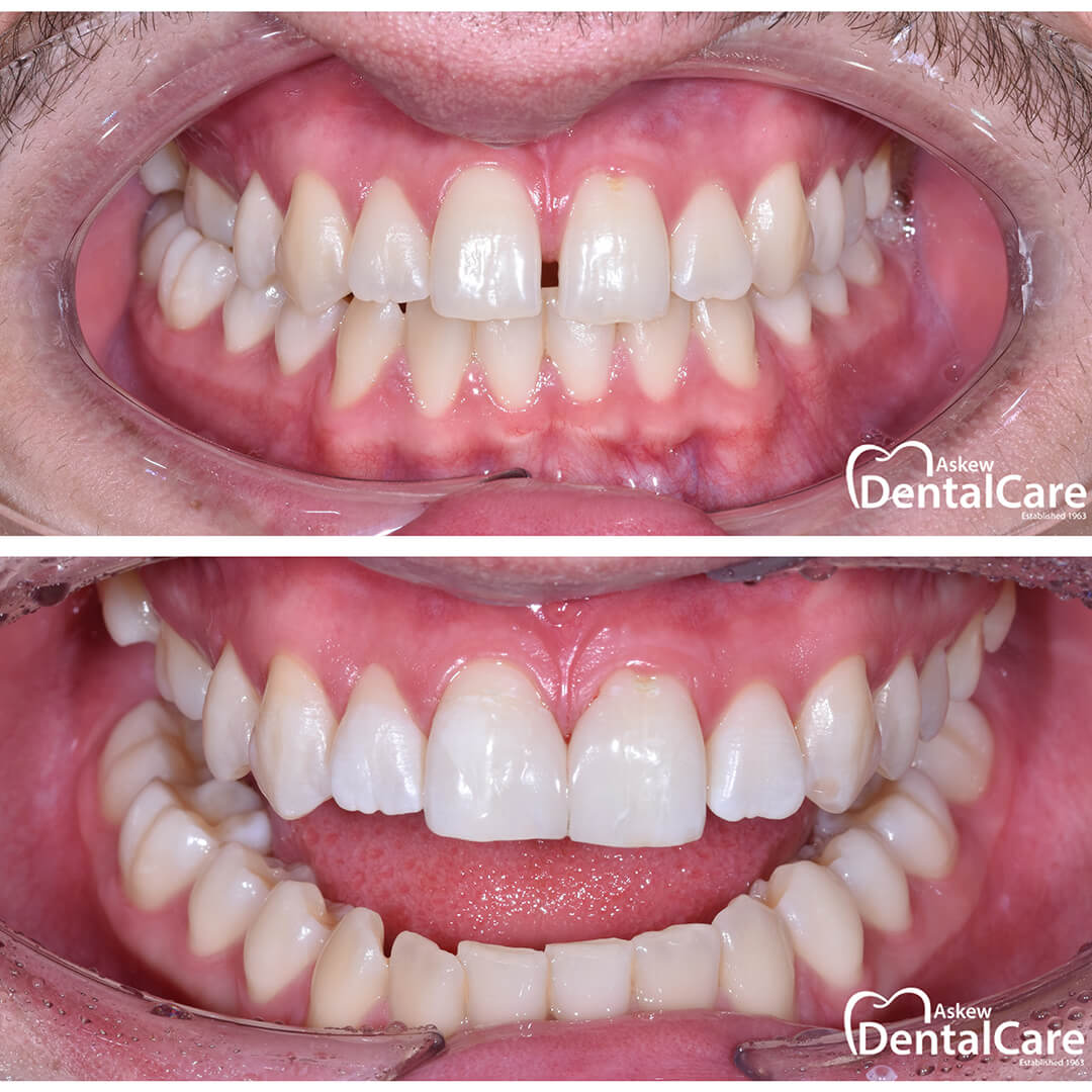 Composite-bonding-before-after-askew