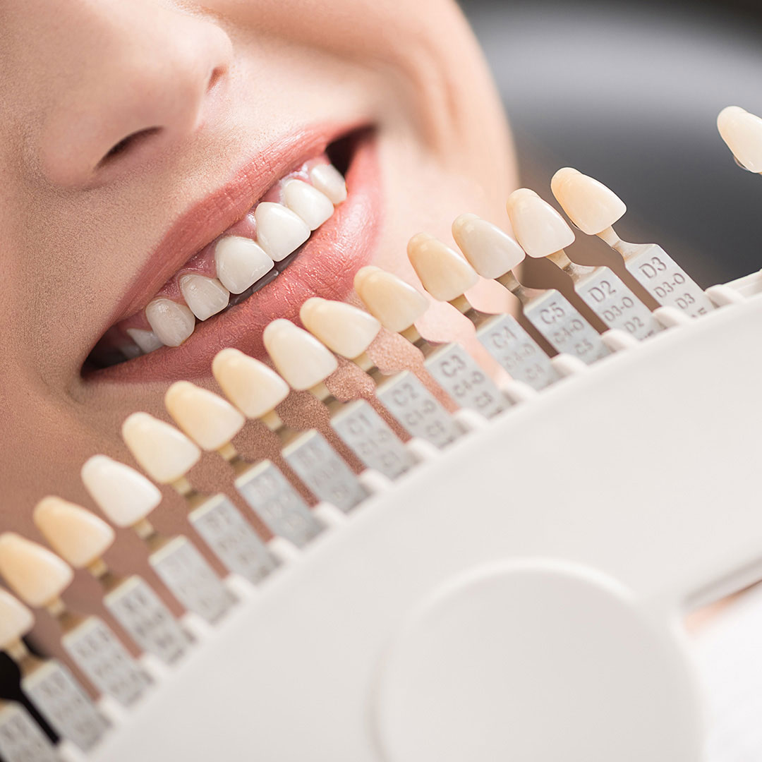 askew-dental-veeners-treatment