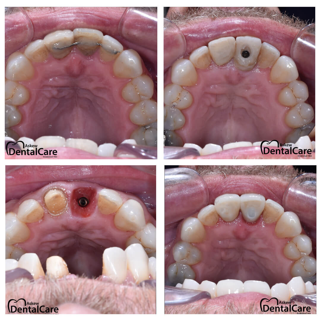 before-after-dental-implant
