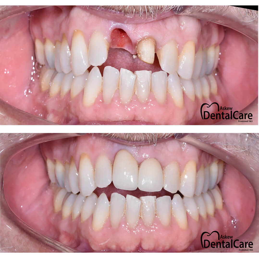 dental-implant-before-after